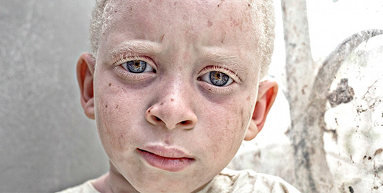 Imagen de la noticia Albinismo: exposición fotográfica y cortometraje